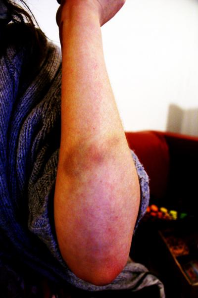 My bruised arm