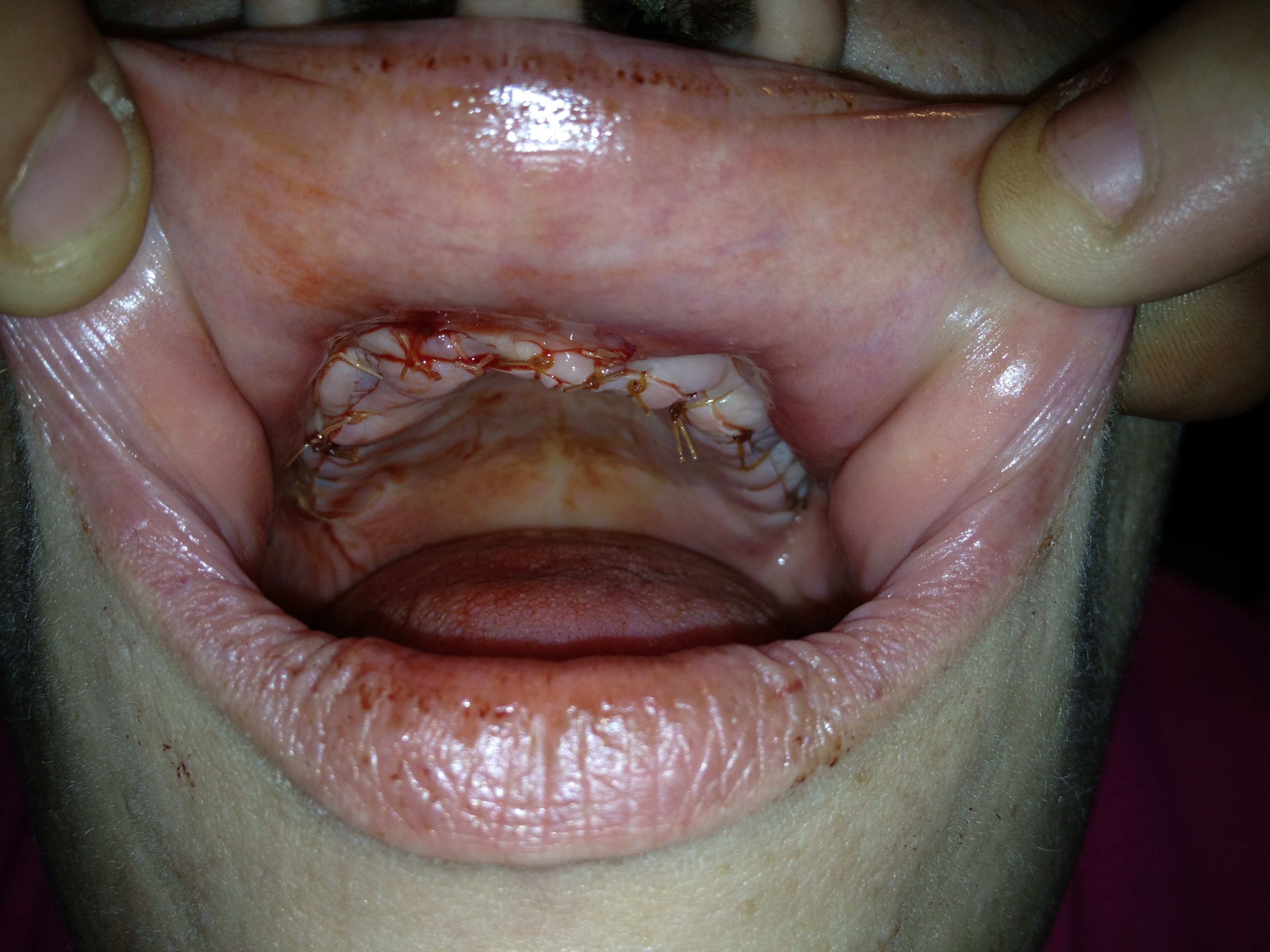 this was after a corrective surgery  ...bone grafting . 