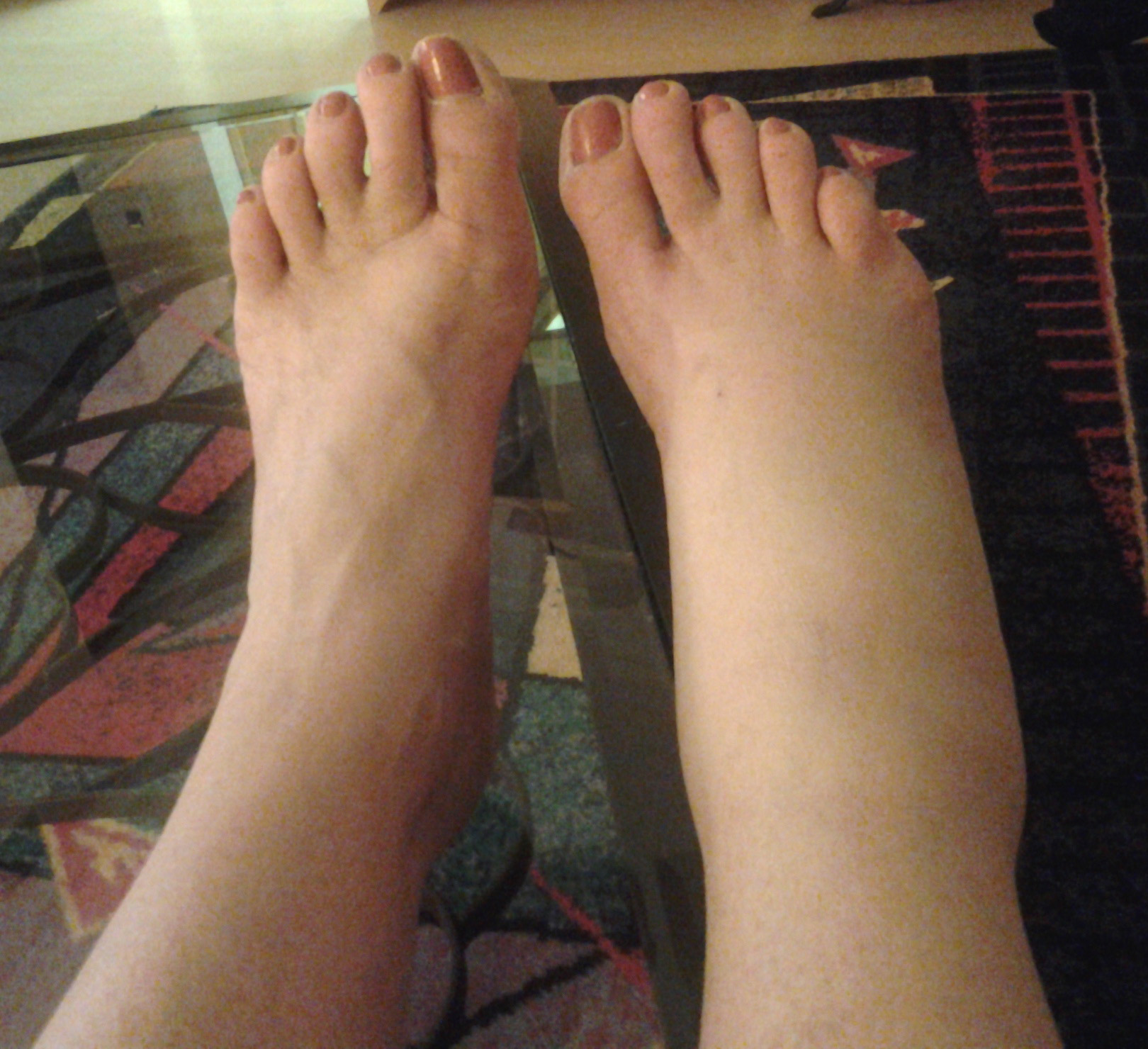 Swollen foot from the visit at The Skin Care Clinic