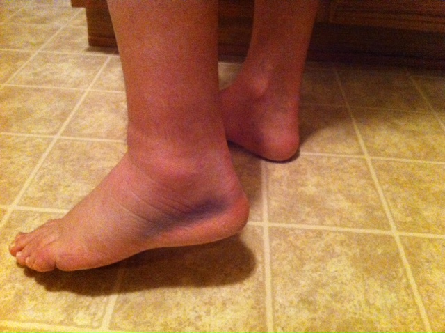 Ankle injury that occurred at Chipotle (Orlando, FL) E. Colonial location.