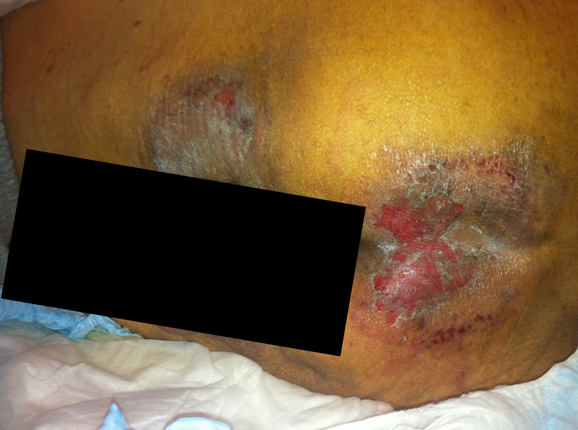 Silverado Hospice Nurse described this as "healing nicely," after advancing from a 1/4" wound...