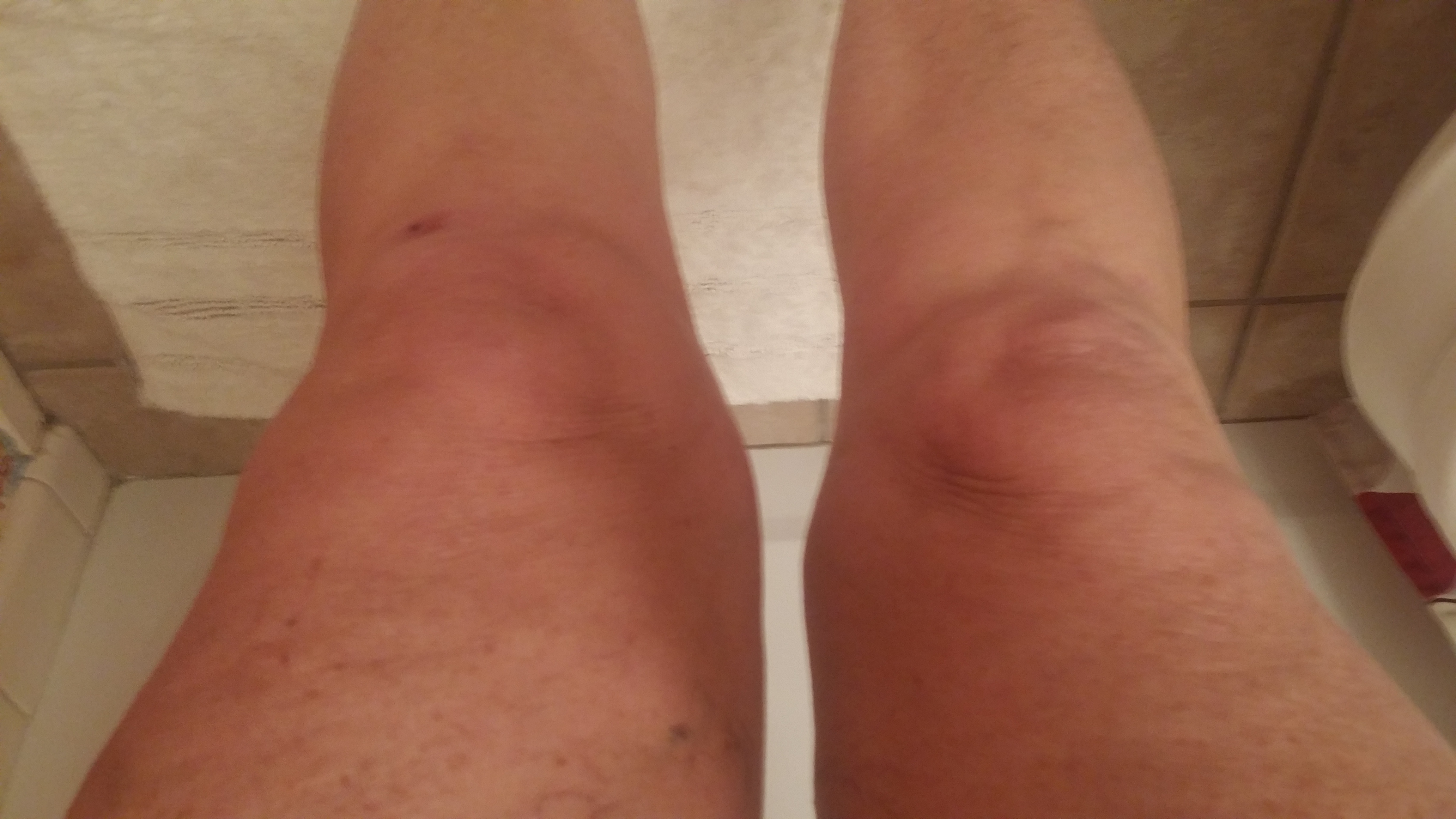 swollen leg