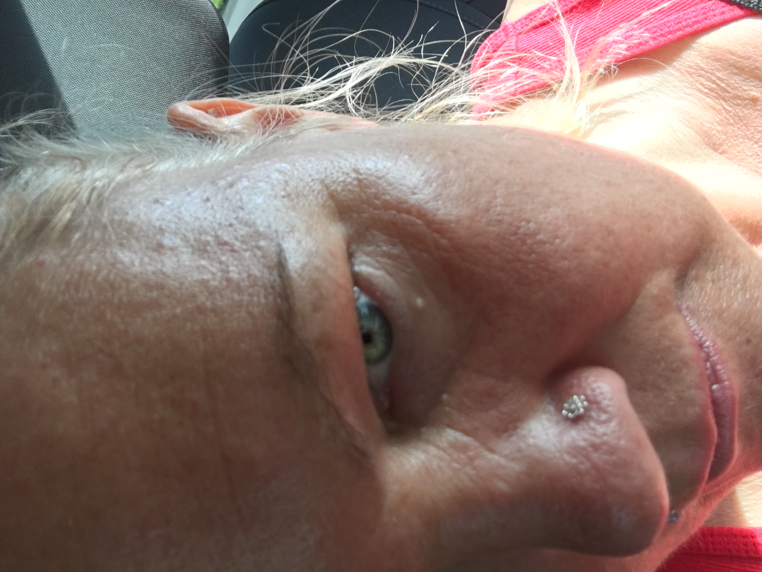 This is after 4 weeks !! Look close there are still crows feet,  very deep lines  under my eyes  and deep lines between my forehead !! Now you tell me is this what she calls 55 units of Botox!! A good