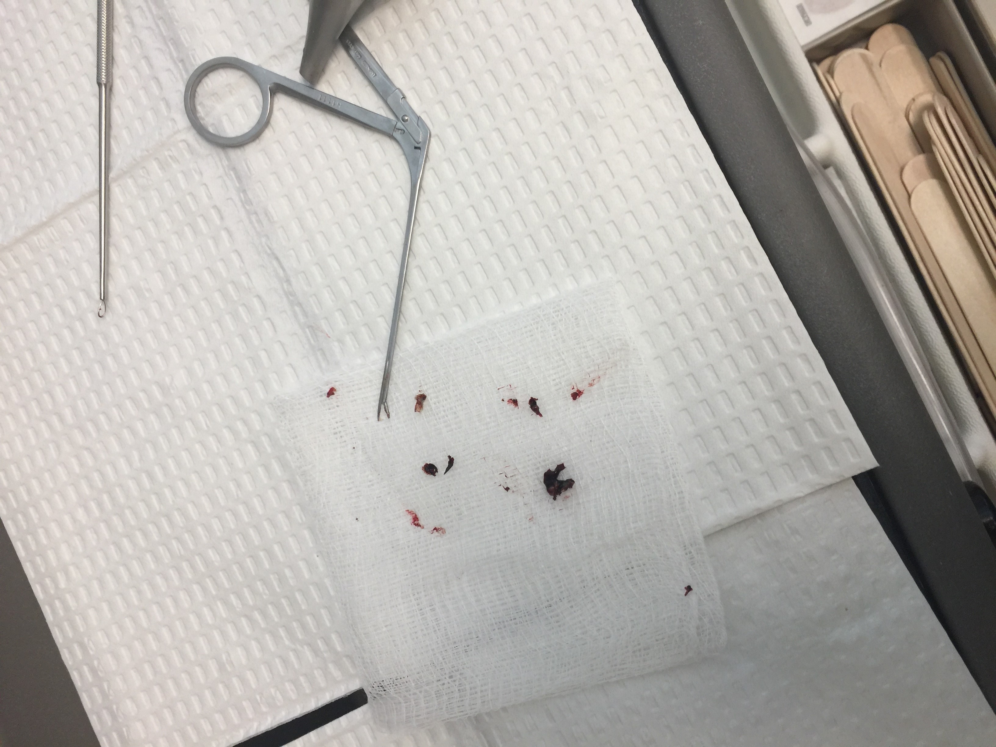 Photo of the blood clots removed by the ENT from my ear canals