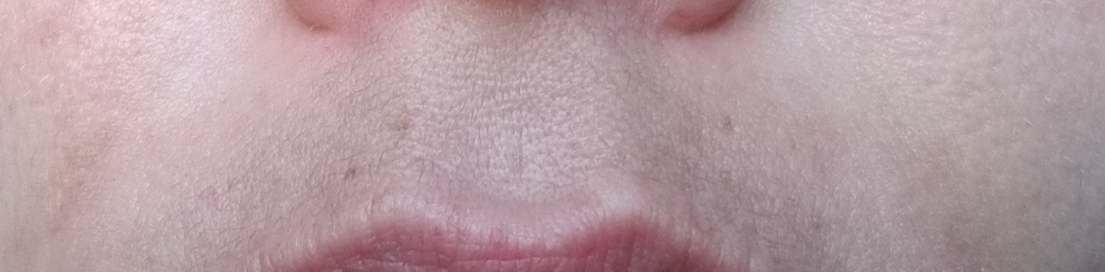 You can see the end of the bruising above both sides of the corners of my lips. The previous photo was from 09/07. I didn't take any of the bruising when it was purple... I was pretty mortified to loo