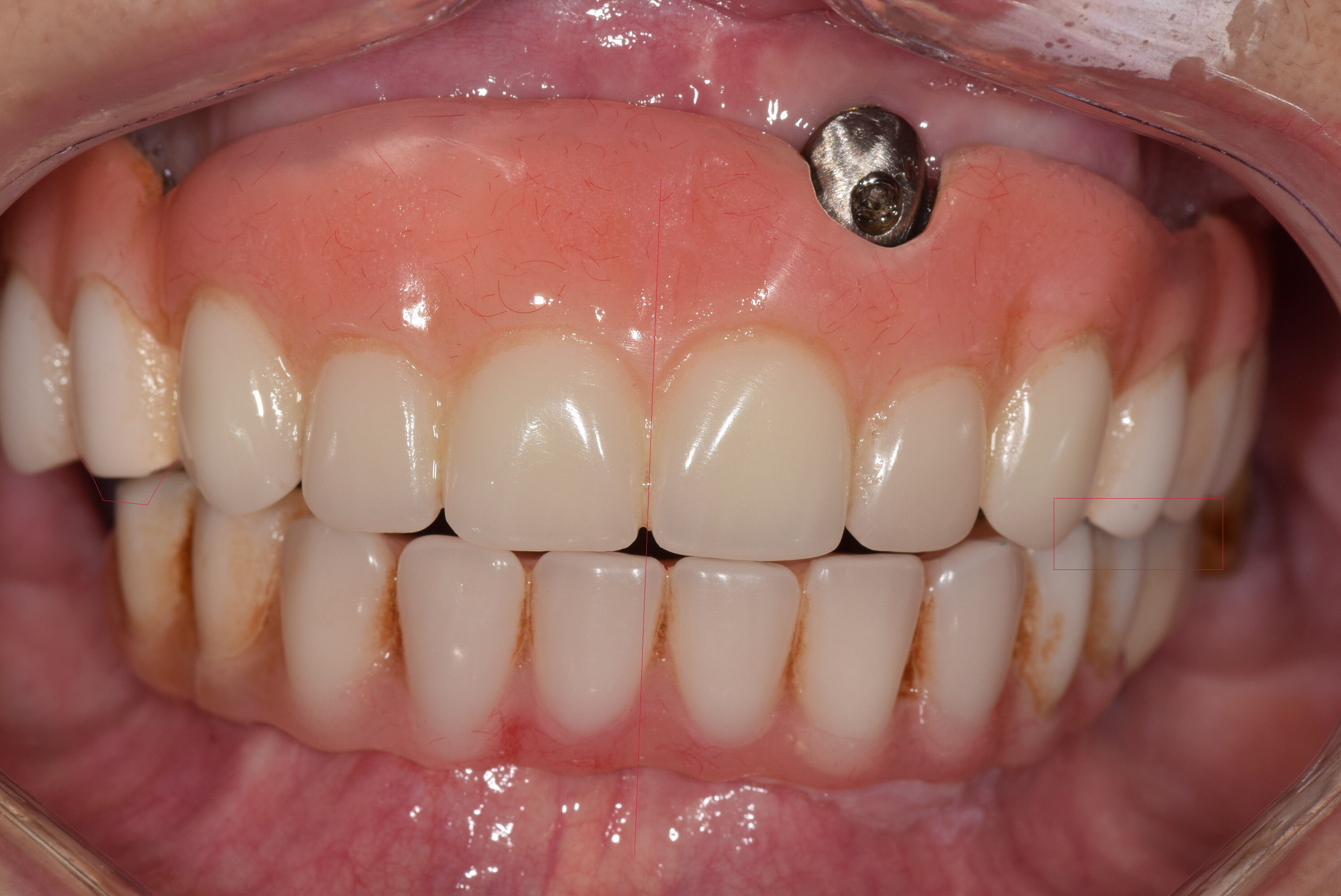 This implant was placed by Dr. Rubinoff