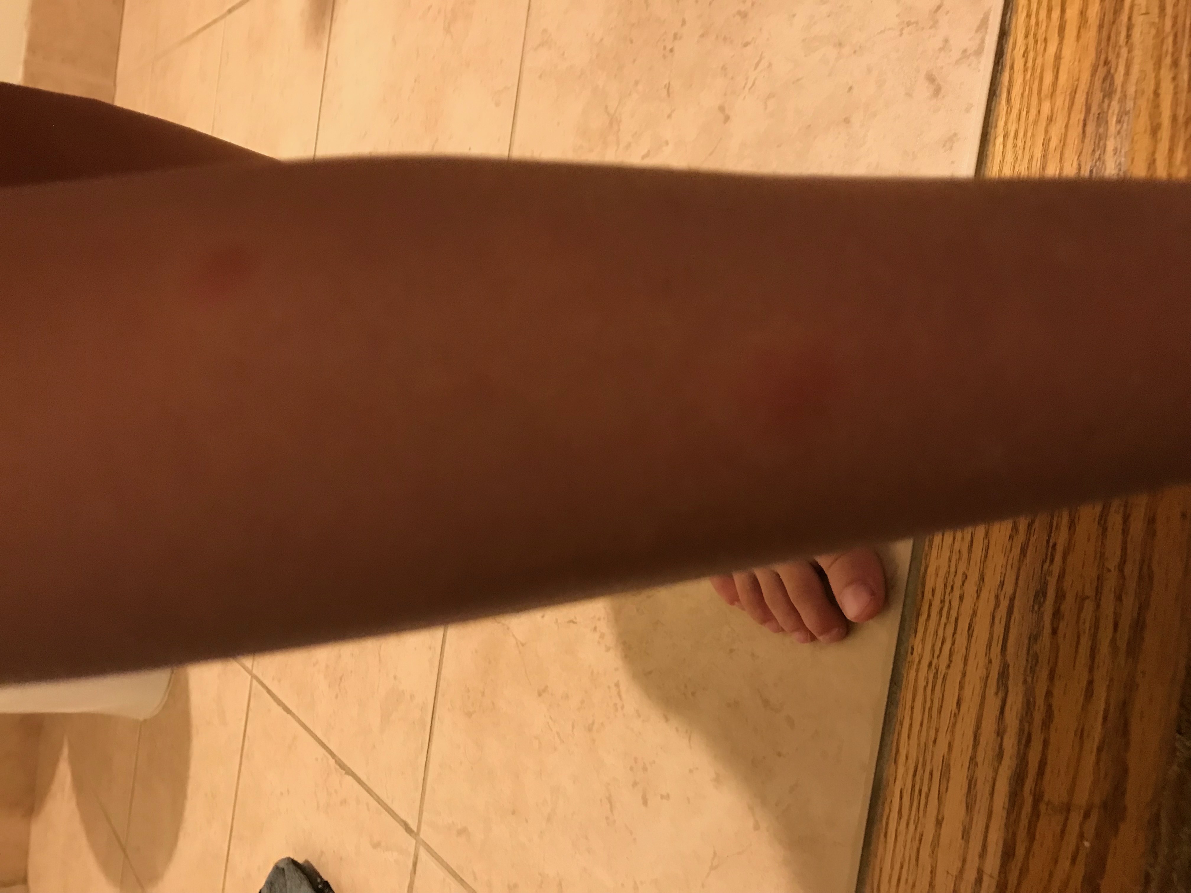 Bug bite on leg from BW hotel