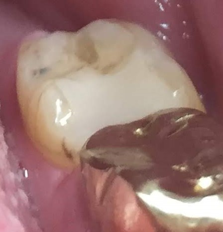 hole in tooth, sharp ridges, then filed more