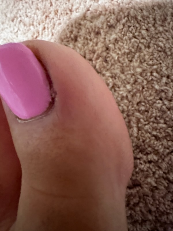 Deep incision from nail salon's pliers show severe