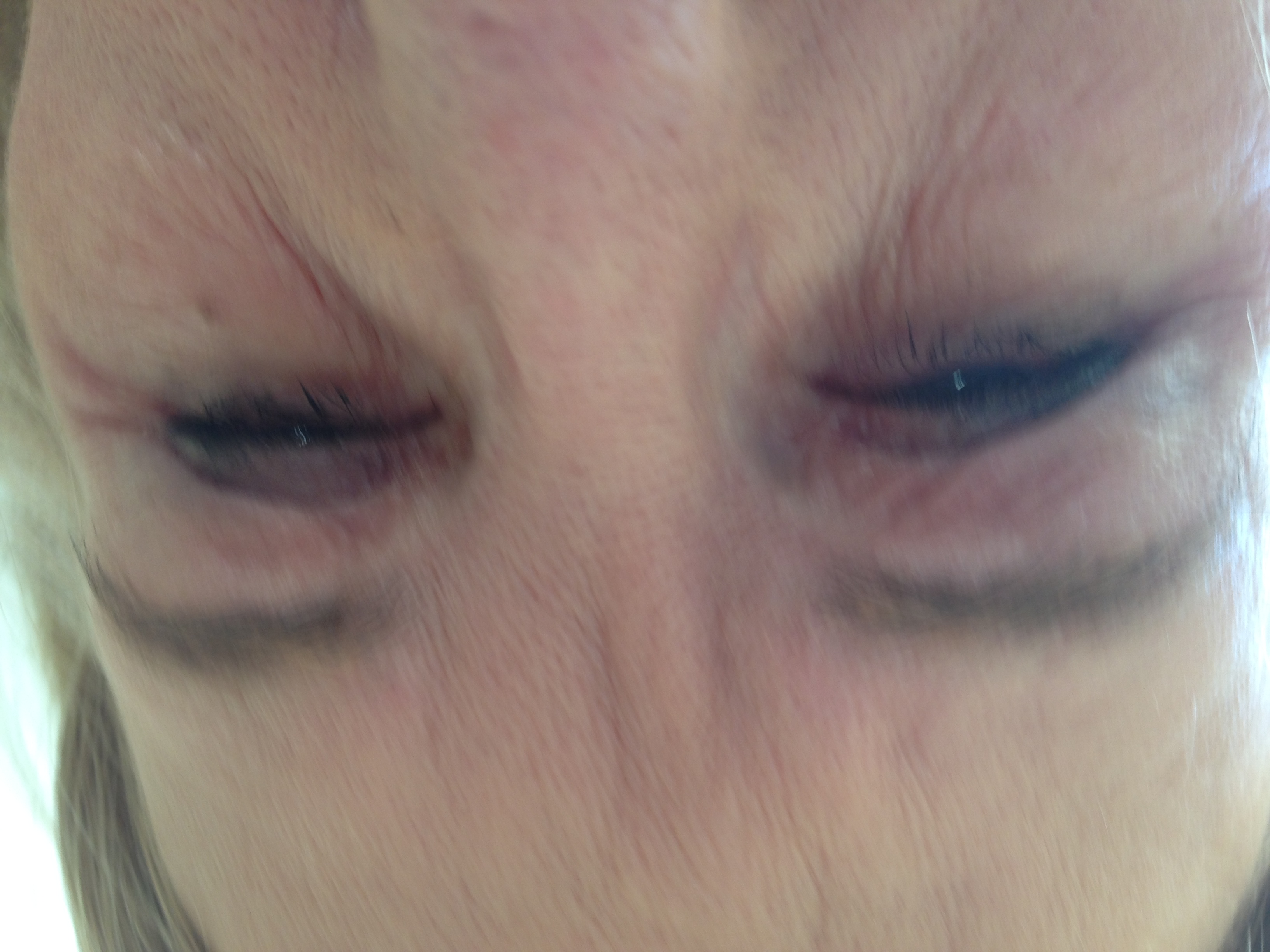 Painful eyes with burns and wrinkles after three nights of RevitaEye