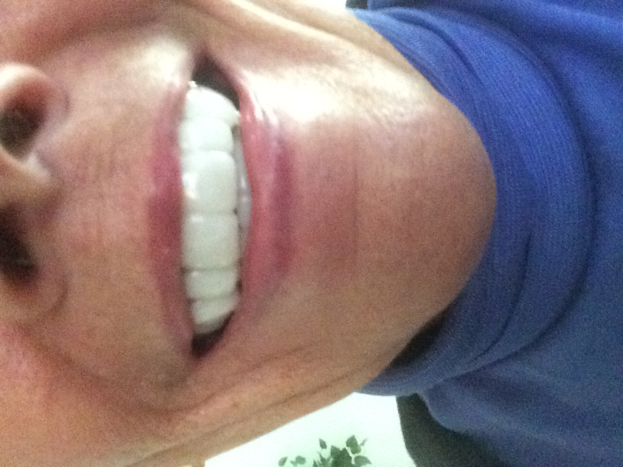 Me with snap on veneers. Teeth so big I can't even smile naturally