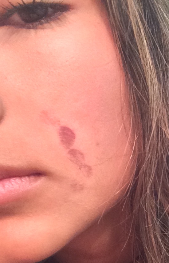 Face burned with Laser hair Removal