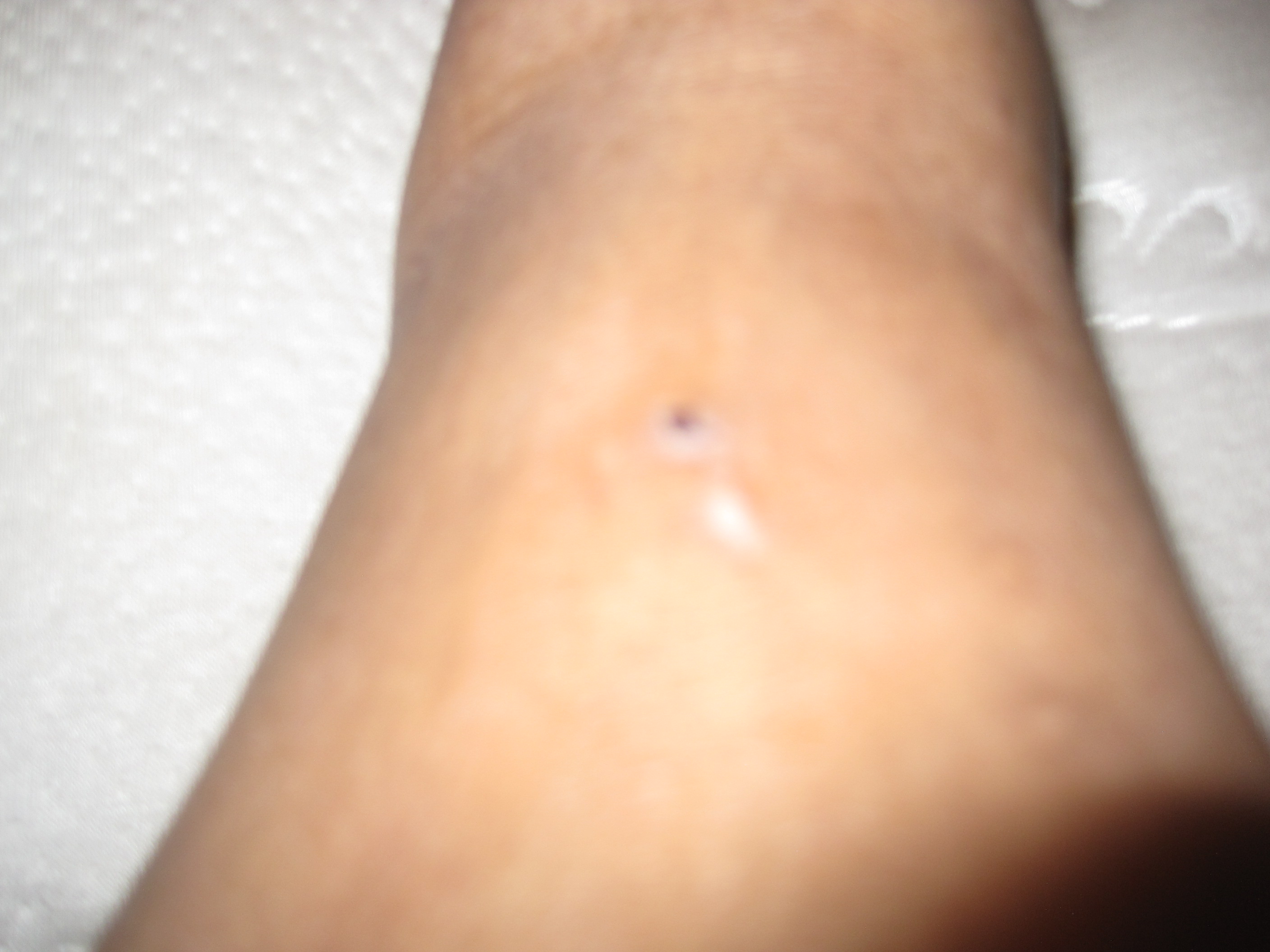 bed bug bite