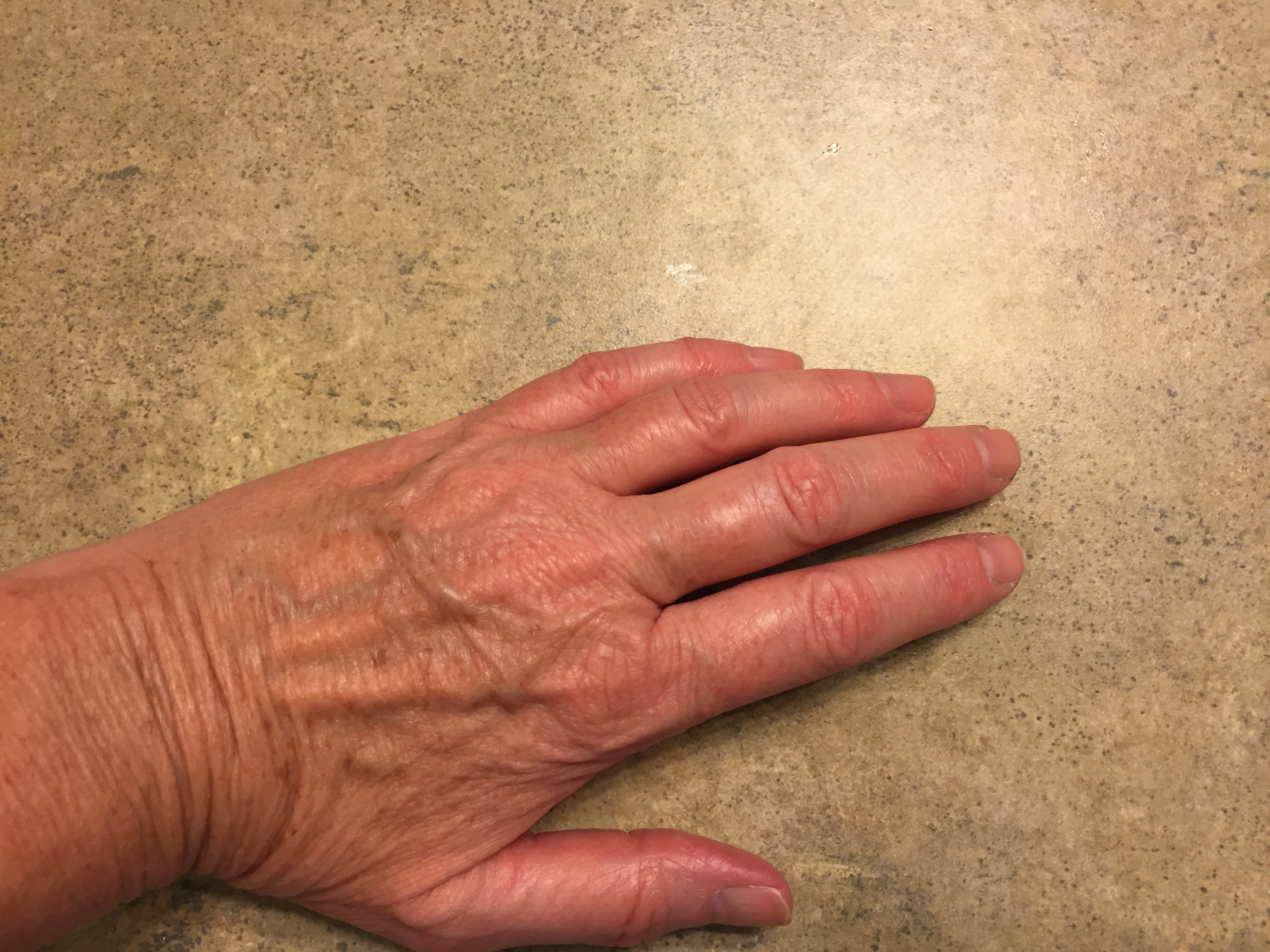 Heat affecting Hands