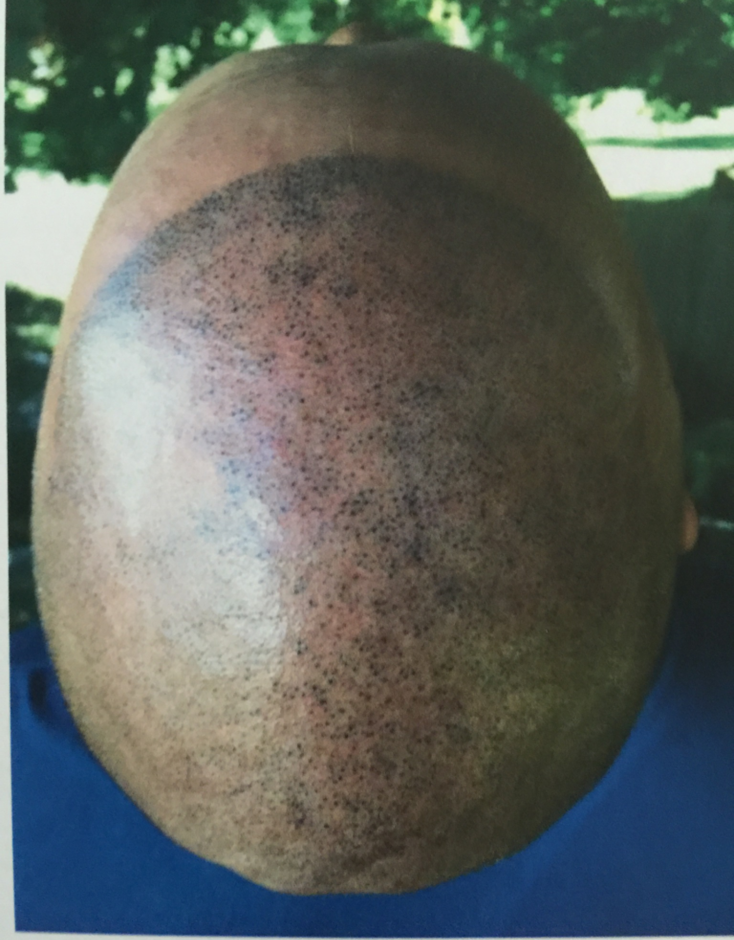 Post 7 to 8 days after treatment