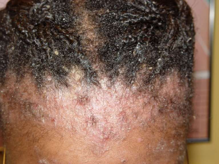 Hair loss and scalp rash