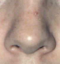 Nose before Kridel surgery (straight on)