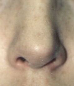 Nose 2.5 years after Kridel surgery (straight on)