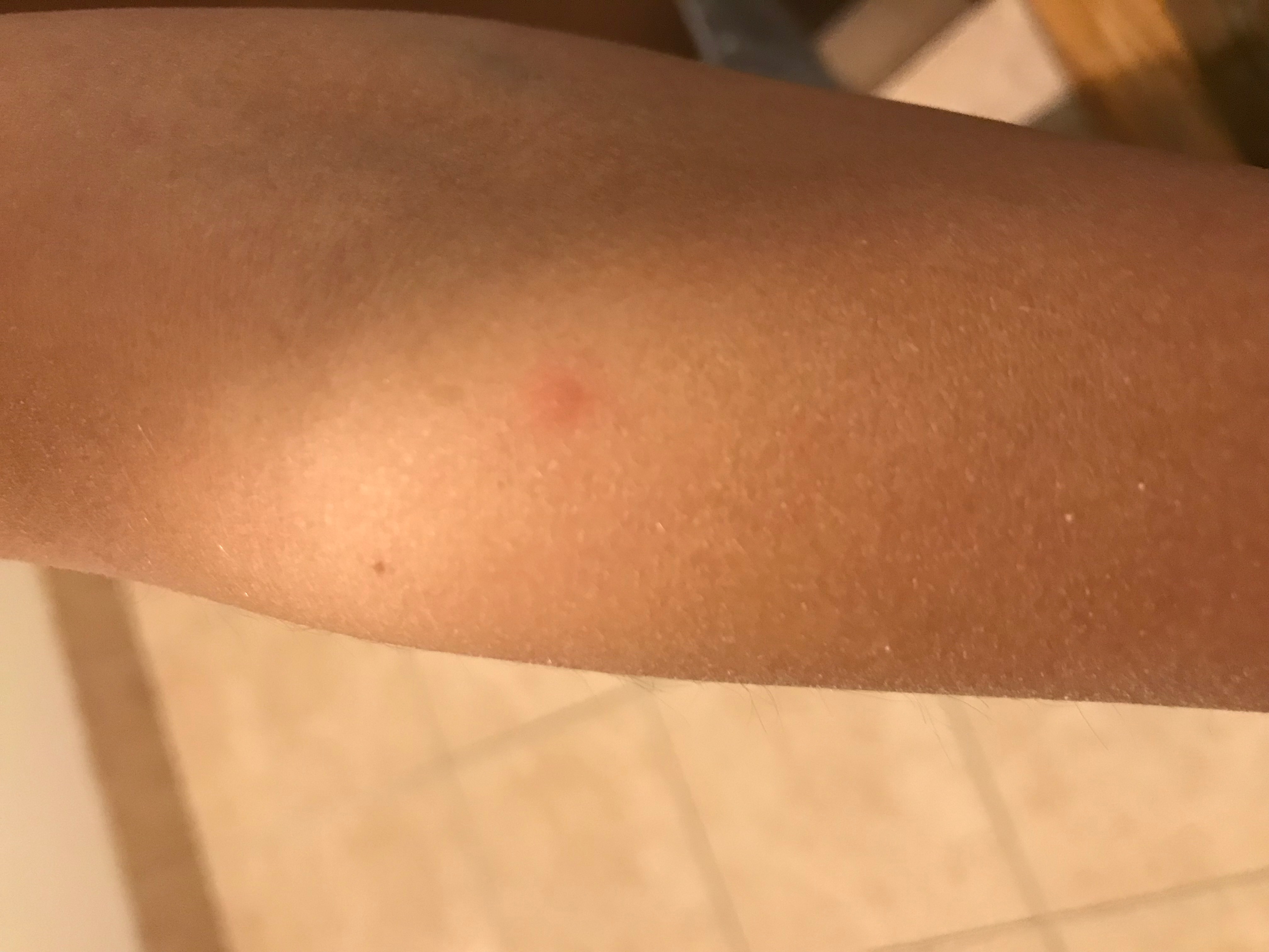 Bug bite on arm from BW hotel