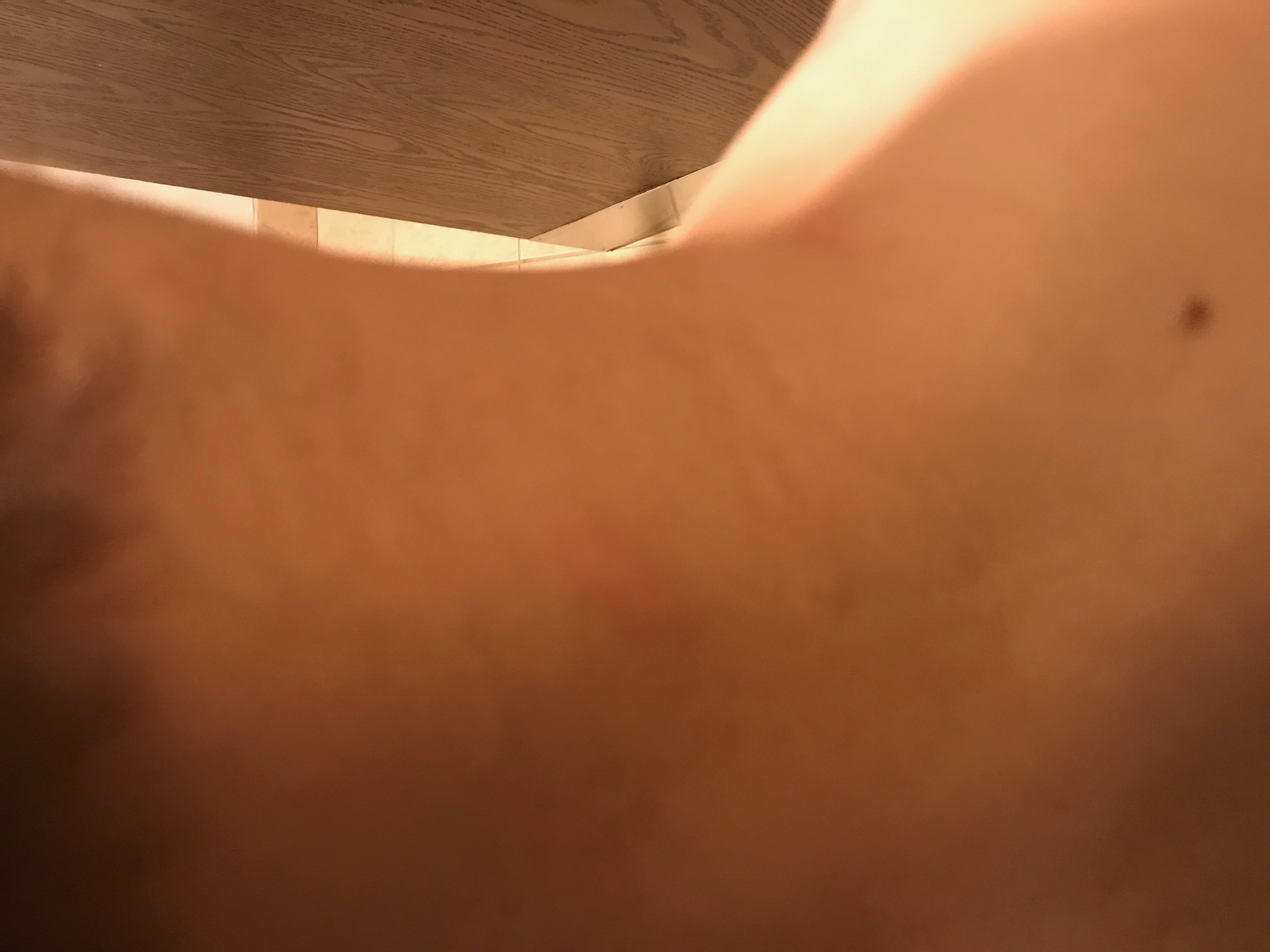 Bug bite on neck from BW hotel