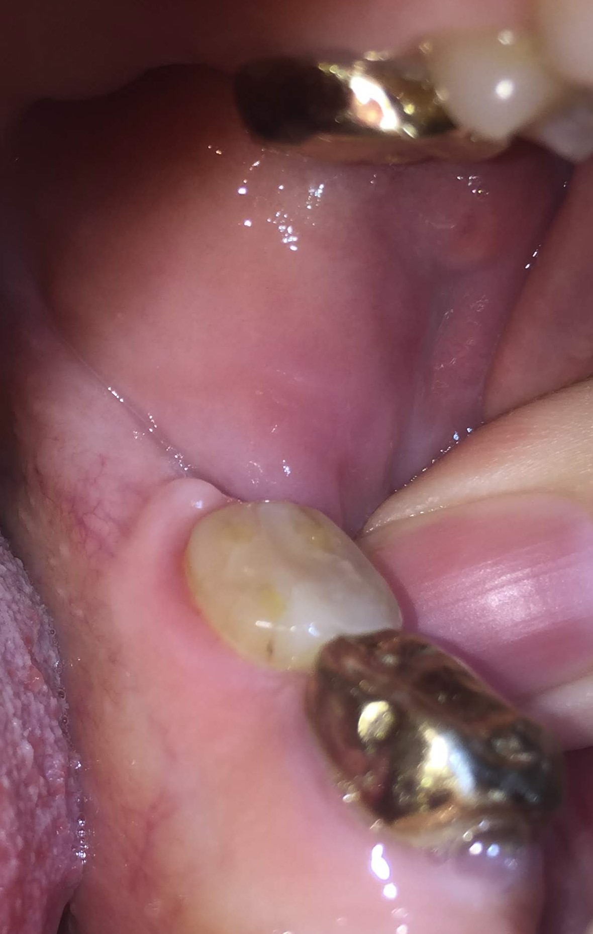 destroyed tooth, unwarranted  